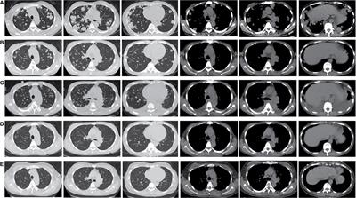 Peripheral Lung Squamous Carcinoma With ROS1 Rearrangement Sensitive to Crizotinib: A Case Report